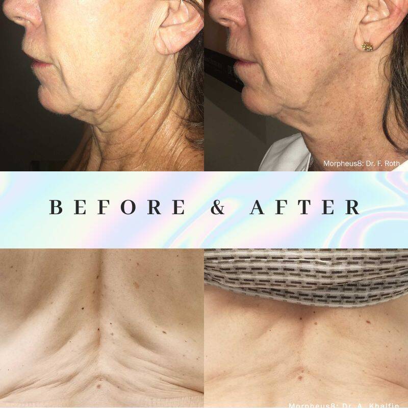 【即決歓迎】９月上旬売切Morpheus　DROPTUNE　MIYAVI使用機材 MIYAVI -使用機材- | m.u.t.e